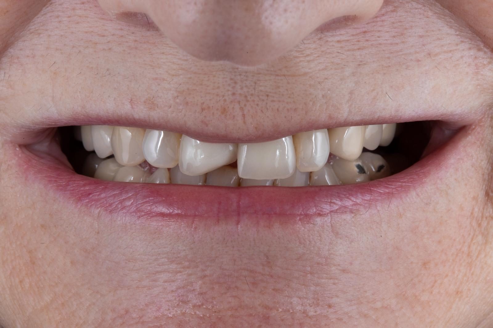 Antes - reconstrucción estética