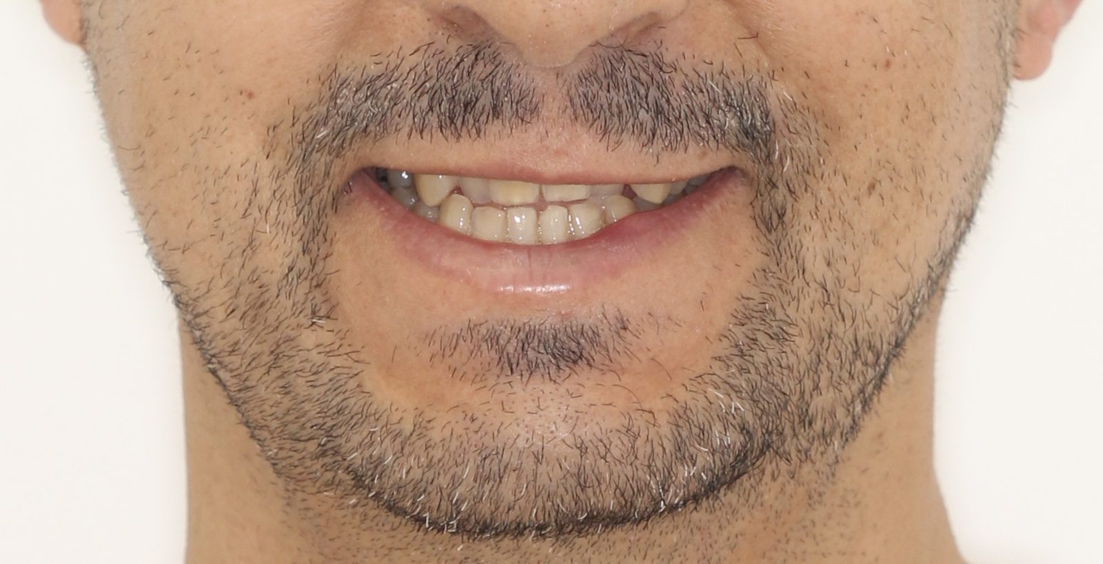 Antes - brackets