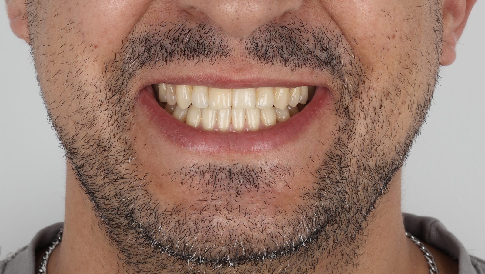 Después - brackets