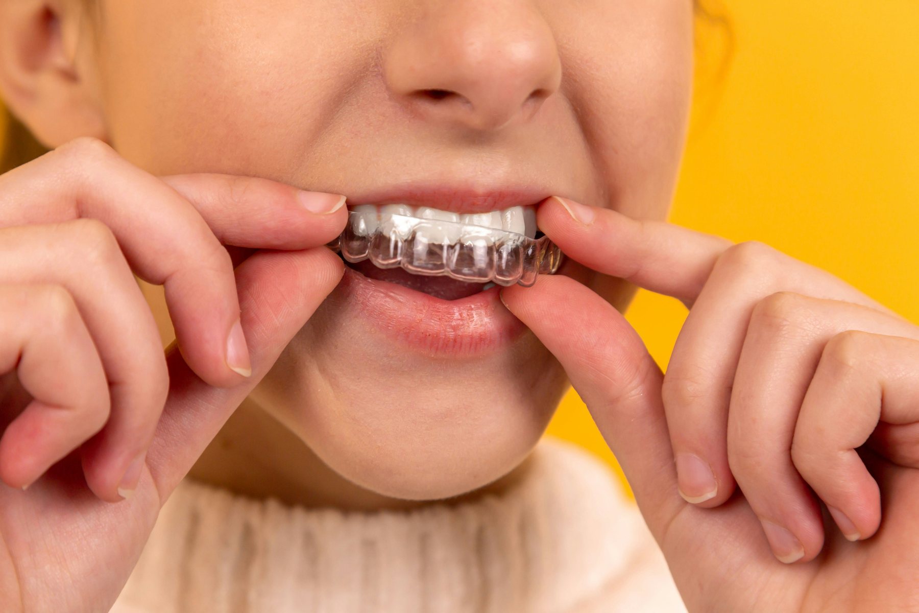 Ortodoncia invisible Invisalign en el Bages