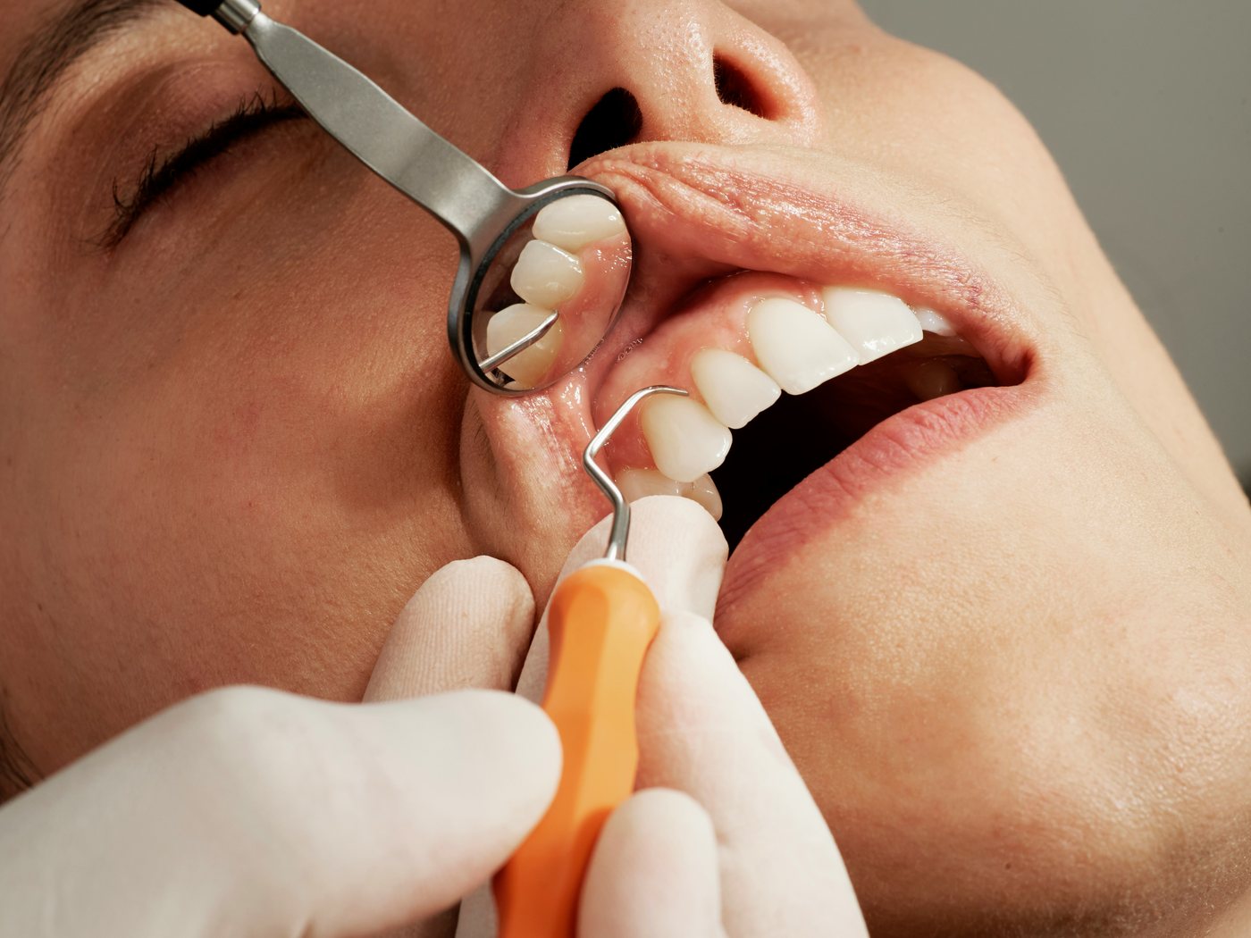 Periodoncia en Sant Vicenç de Castellet - detalle